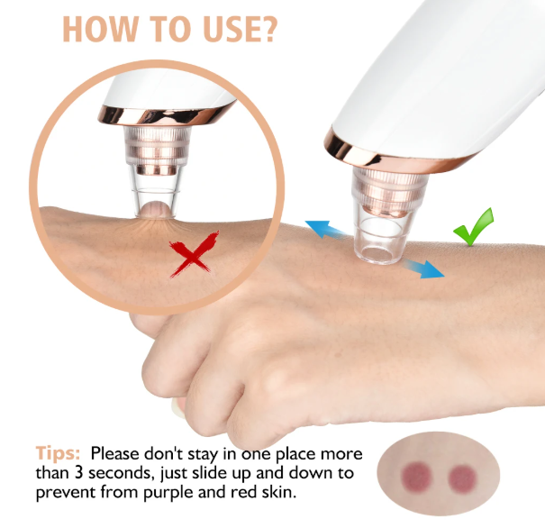 Blackhead Remover